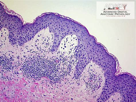 Polymorphous Light Eruption Histology