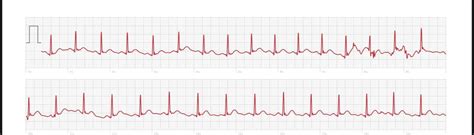 7-10s Of one lead ECG chest pain. Felt like a pvc. Thoughts? : r ...