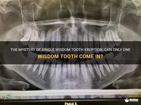 The Mystery Of Single Wisdom Tooth Eruption Can Only One Wisdom Tooth Come In Medshun