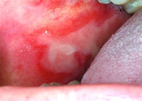 Hairy Cell Leukemia Tongue