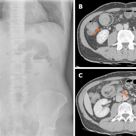 Inflammatory Fibroid Polyp Of The Small Intestine A Year Old Male