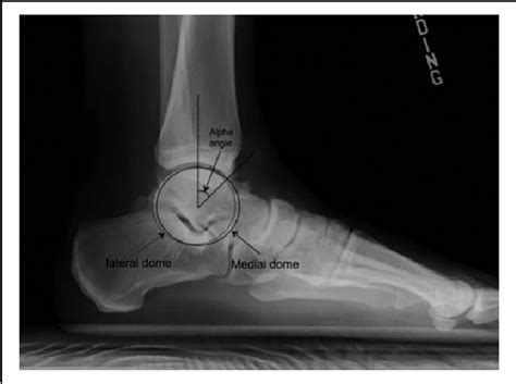 Figure 3 From Anteromedial Ankle Impingement Due To A Talar Cam Lesion