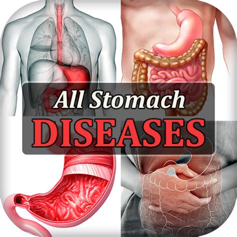 Stomach Diseases & Treatment - Apps on Google Play