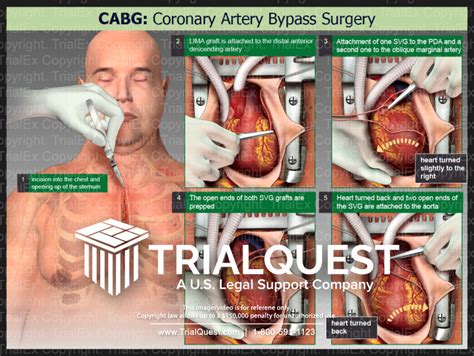 Cabg Coronary Artery Bypass Surgery Trialquest Inc