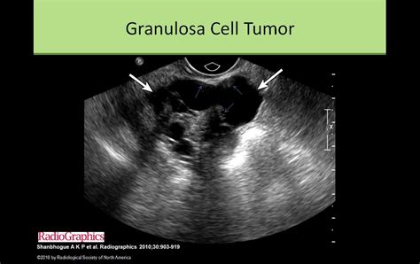 granulosa cell tumor | Tumor, Pathology, Gynecology