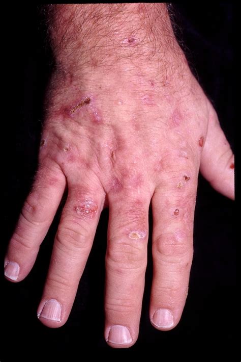 Dermatologic Disorders Associated With Chronic Hepatitis C Effect Of