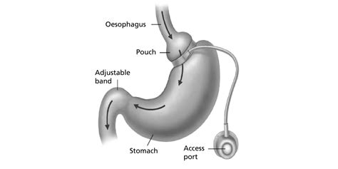 Laparoscopic Gastric Band Post Procedure South Tees Hospitals Nhs