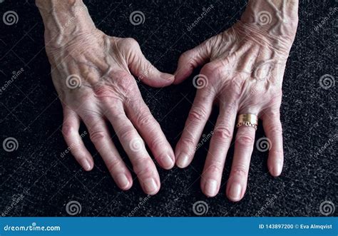 Rheumatica Womans Hand With Heumatoid Arthritis Hands And Fingers