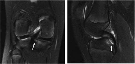 Coronal And Sagittal Magnetic Resonance Imaging Of The Right Knee