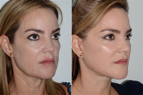 Lifting Facial Facelift Fotos Coral Gables Fl Paciente