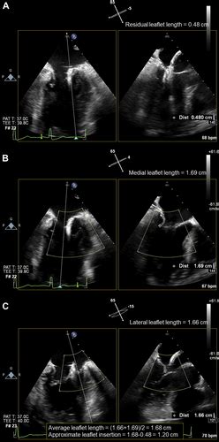 A Novel Method To Quantify Leaflet Insertion During Transcatheter