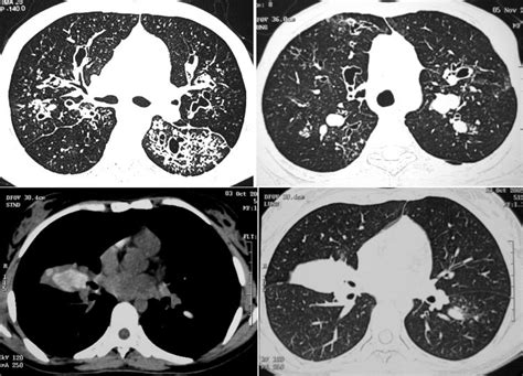 Hrct Images Of Different Patients With Allergic Bronchopulmonary