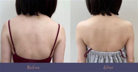 Shoulder Botox Treatment At Id Cosmetic Clinic Relieve Muscle Tension