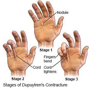 Dupuytren Contracture (Aftercare Instructions)