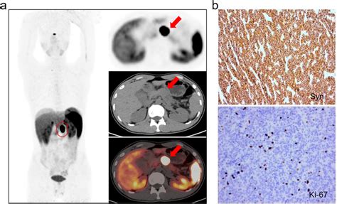 a Case report of pancreatic neuroendocrine tumor ⁶⁸Ga DOTATATE PET CT