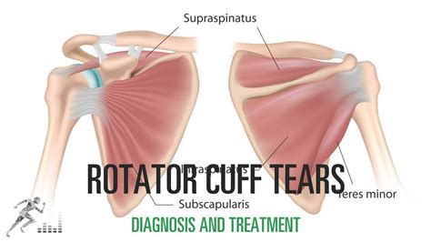 Rotator Cuff Tear Diagram