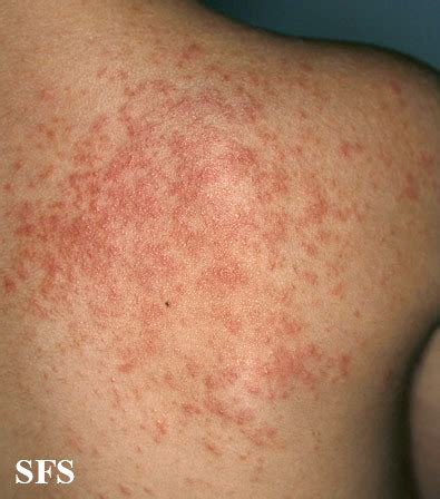 Itchy Back Rash Pictures, Skin Problems and Other Causes | Healthhype.com