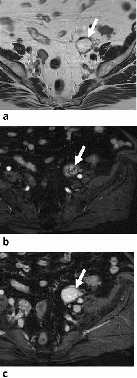 Anastomosing Hemangioma Of The Ovary In A 70 Year Old Female Axial T2