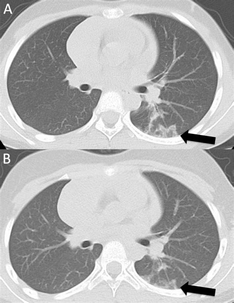 Chest Computed Tomography Ct Findings A A Ground Glass Opacity Was Download Scientific