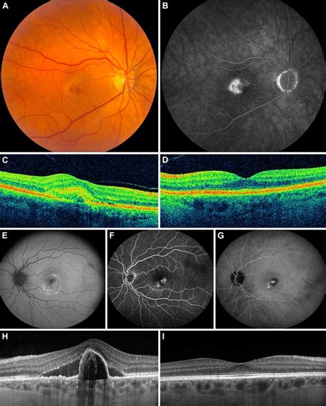 Age Related Macular Degeneration