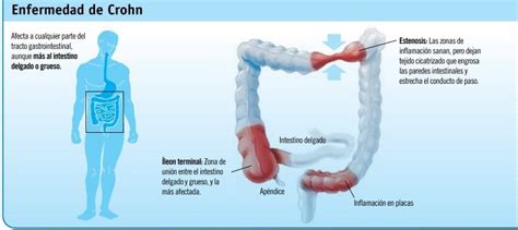 La Enfermedad De Crohn TrainerClub