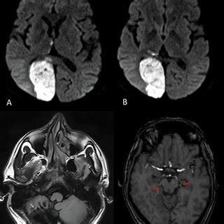 A Acute Infarct With Small Areas Of Haemorrhagic Transformation