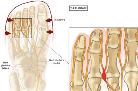 Névrome interdigital névralgie de Morton Karteikarten Quizlet