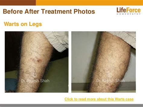 Warts Before and After Treatment Photos: Find Pictures of Cases Treat…