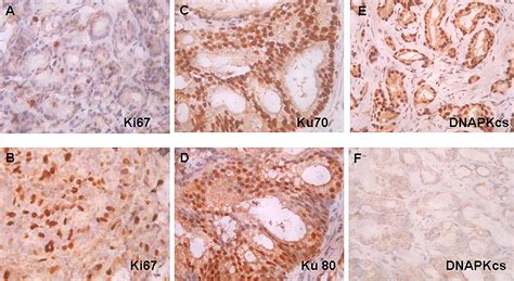 Dna Pkcs Expression Predicts Response To Radiotherapy In Prostate