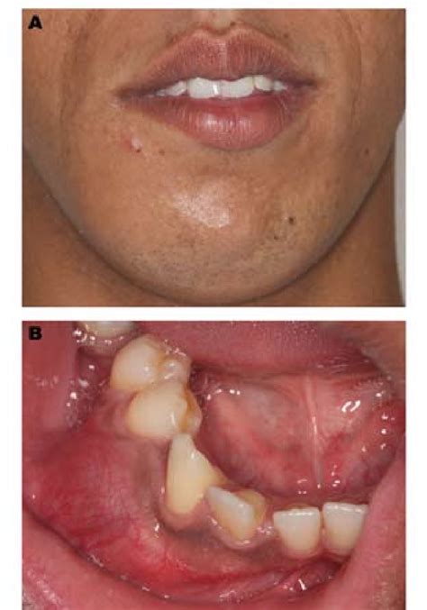 Alveolar Mucosa Color