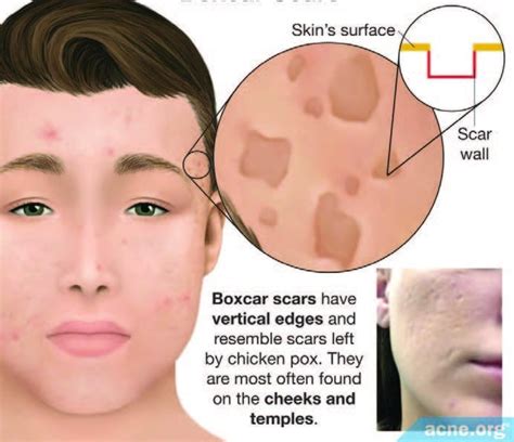 Acne Scars Skinpen Precision By Crown Aesthetics