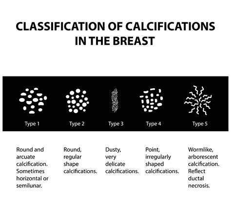 Classification,Of,Calcifications,In,The,Mammary,Gland.,Mammography.,The,Mammary | Fairfield ...