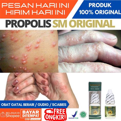 Jual Obat Gatal Berair Dan Bernanah Obat Kutu Air Di Tangan Di Sela