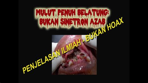 Mulut Penuh Belatung Ini Penjelasan Ilmiahnya Maggots Inside Our