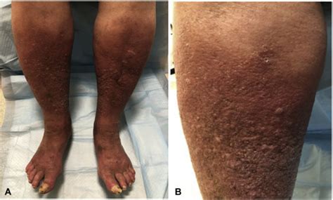 An Atypical Presentation Of Pretibial Myxedema In A Euthyroid Patient With Absent Antithyroid