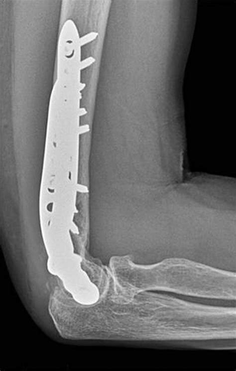 Fragility Fractures Of The Distal Humerus Bone Joint