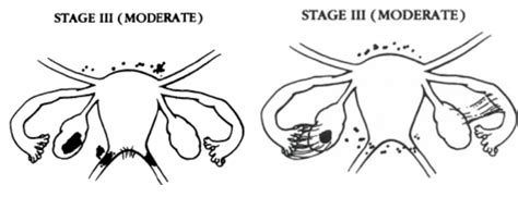 Endometriosis: Symptoms, Causes and Treatment