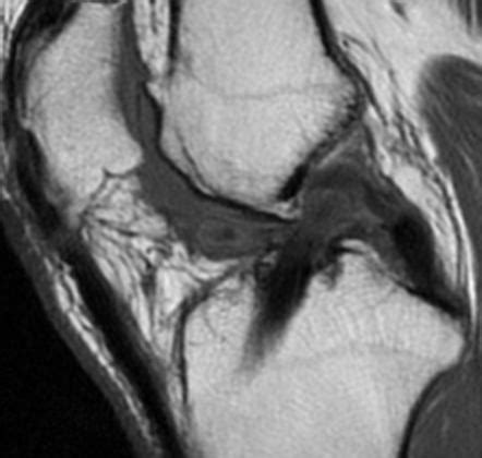 Cyclops Lesion Knee Radiology Reference Article Radiopaedia Org