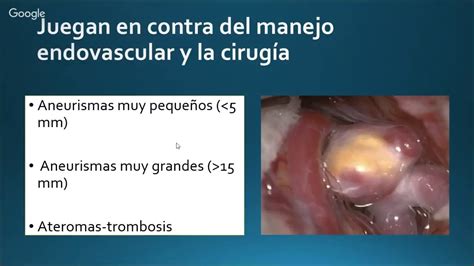 Indicaciones De Cirug A En Aneurismas Cerebrales Youtube