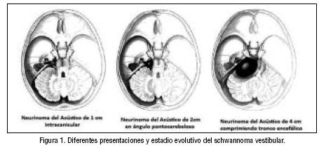 Neurinoma del acústico schwanoma vestibular Revisión y actualización