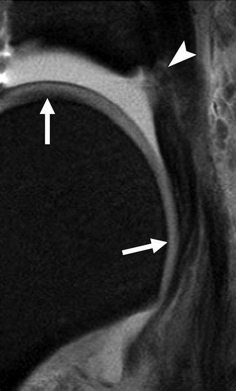 MRI Of The Metatarsophalangeal Joints Improved Assessment With Toe