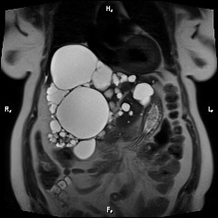 Polycystic liver disease | Radiology Case | Radiopaedia.org