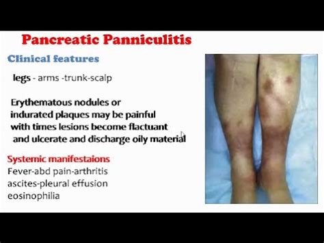 Pancreatic Panniculitis Youtube