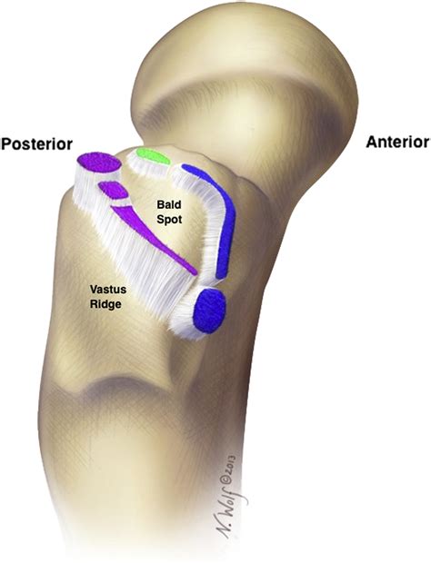 Endoscopic Repair Of Full Thickness Abductor Tendon Tears Surgical