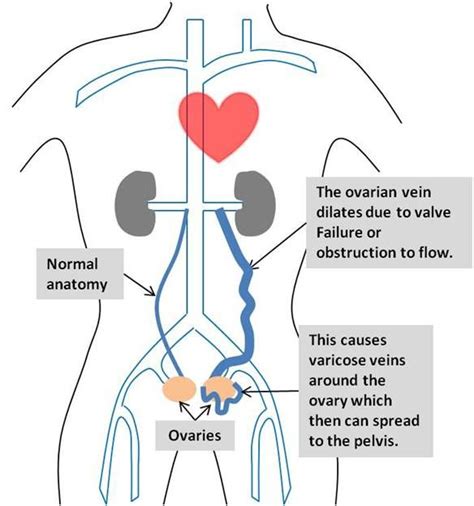 Pelvic Venous Congestion Syndrome | Pelvic congestion syndrome ...