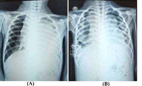 Chest X-ray posteroanterior view (A) on admission showed a right-side ...