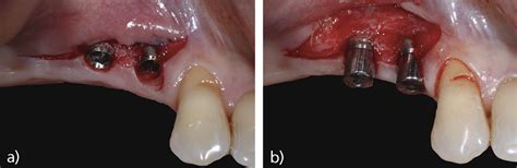 Microcirug A Aplicada A La Reconstrucci N Gingival Y Periodontal