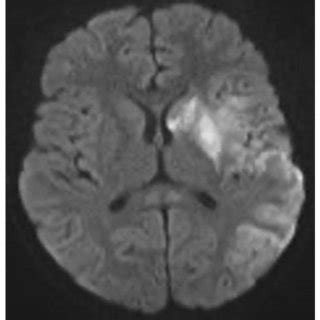 Diffusion Axial Slice Of Mri Brain Showing Areas Of Restriction On