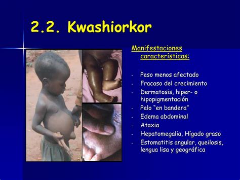 Ppt Problemas Nutricionales I Marasmo Y Kwashiorkor Powerpoint Presentation Id4959031