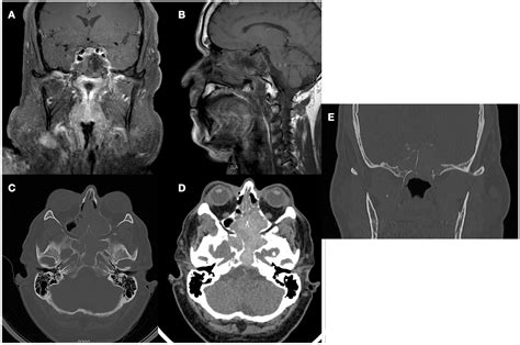 Allergic Fungal Sinusitis Imitating An Aggressive Skull Base Lesion In The Setting Of